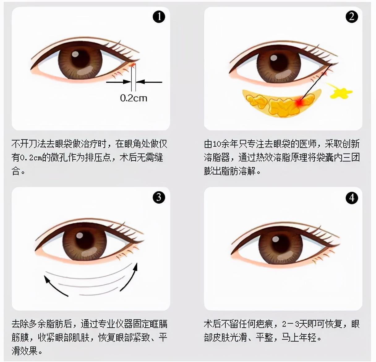 现代科技革新下的眼袋消除方法与眼部美容探索