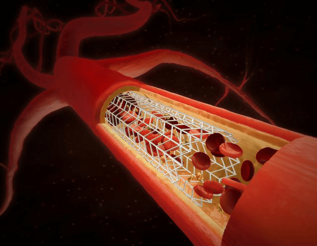 心脏血管堵塞最新开通技术，重塑心血管健康的希望之路