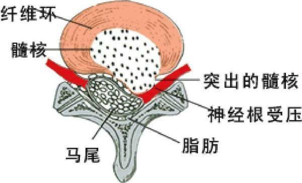 腰间盘突出最新疗法，革新治疗，希望之光照亮康复之路